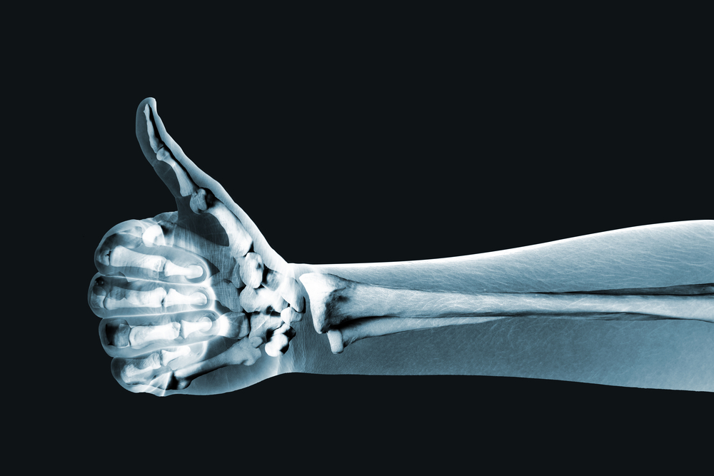x-ray of arm and hand giving thumbs up