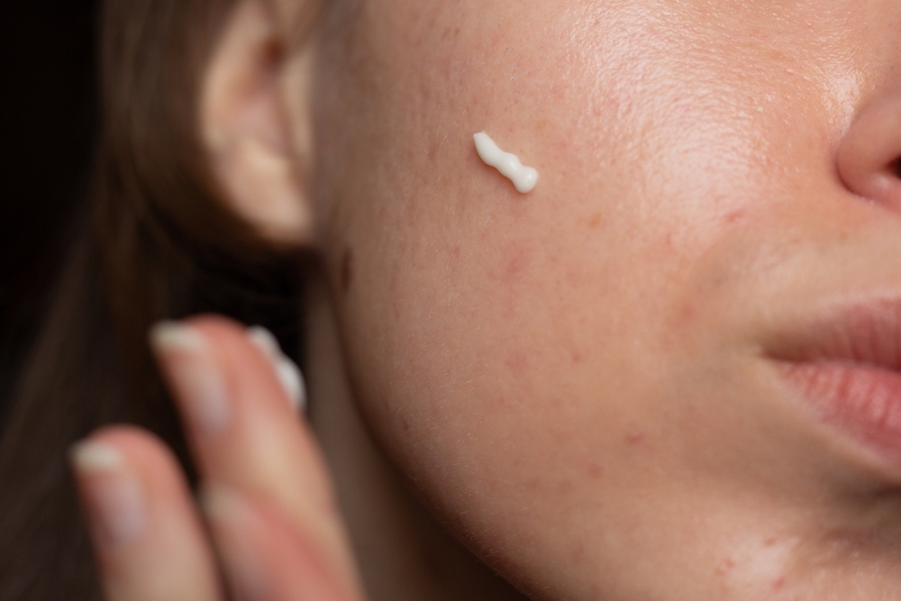 applying retinoid on cheek